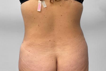 After image 4 Case #132801 - Tummy Tuck