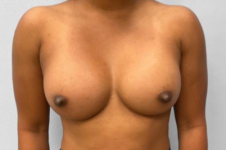 After image 1 Case #132796 - Breast Augmentation