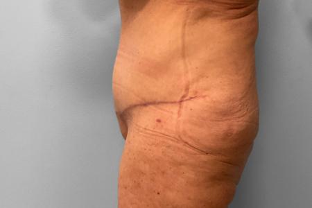 After image 3 Case #132781 - Tummy Tuck