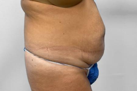 Before image 2 Case #132801 - Tummy Tuck