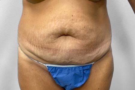 Before image 1 Case #132801 - Tummy Tuck