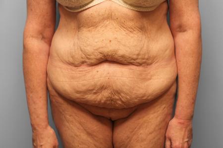 Before image 1 Case #132781 - Tummy Tuck