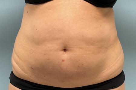 Before image 1 Case #131601 - 55 y.o. female with Lipo and Tummy Tuck