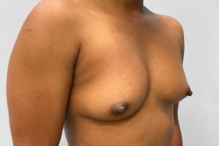 Before image 2 Case #132796 - Breast Augmentation