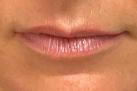 Before image 1 Case #132306 - 49 y.o. female with Botox (Lip Flip)