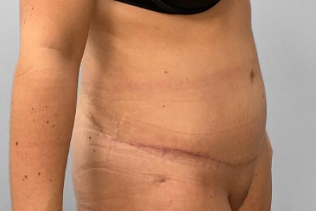After image 2 Case #132801 - Tummy Tuck