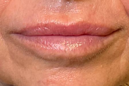 After image 1 Case #133576 - 58 y.o. female with Lip Filler