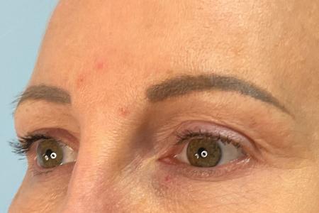 After image 2 Case #133301 - 45 y.o. female with Upper Blepharoplasty