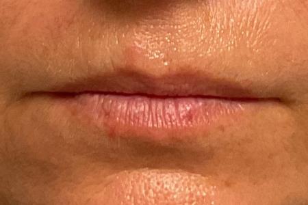 Before image 1 Case #133571 - 51 y.o. female with Lip Filler
