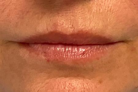 After image 1 Case #133571 - 51 y.o. female with Lip Filler