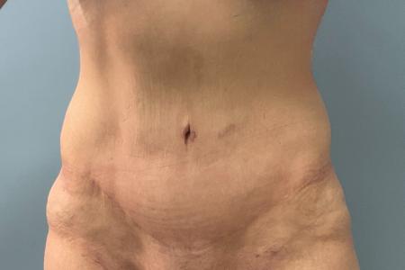 After image 1 Case #133556 - 43 y.o. female with Tummy Tuck
