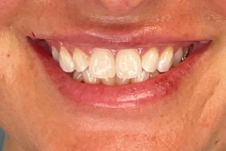 Before image 2 Case #133636 - 27 y.o. with Lip Filler