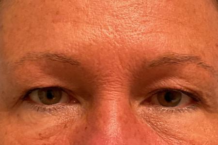 Before image 1 Case #134226 - 59 y.o. female with Upper Eyelid Surgery