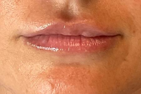 After image 1 Case #133636 - 27 y.o. with Lip Filler