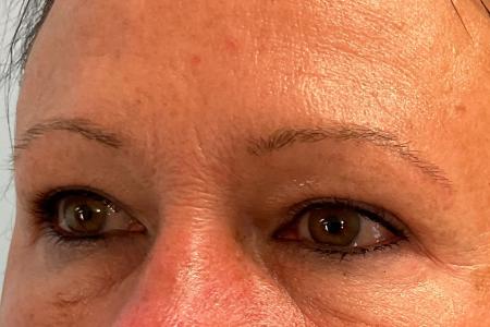 After image 2 Case #134226 - 59 y.o. female with Upper Eyelid Surgery