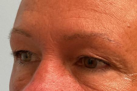 Before image 2 Case #134226 - 59 y.o. female with Upper Eyelid Surgery