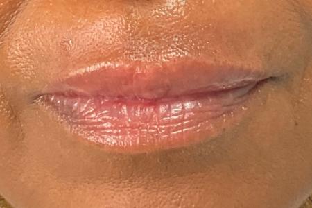After image 1 Case #134151 - 65 female with Lip Filler to Upper Lip