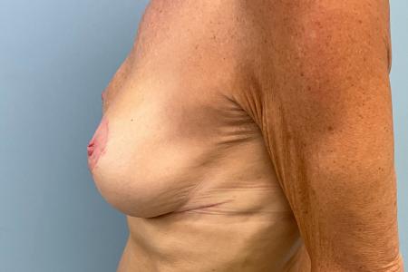 Before image 3 Case #134366 - 64 y.o. female w/ VI Peel for Breast Scars