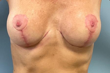 Before image 1 Case #134366 - 64 y.o. female w/ VI Peel for Breast Scars