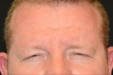 Before Case #86391 - 40 year old man treated with Botulinum Toxin