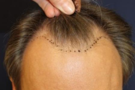 Before Case #87391 - Hair Transplantation San Diego