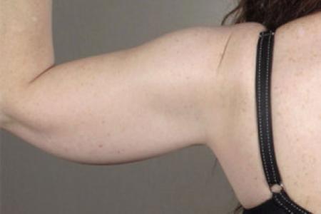 Before image 4 Case #103206 - Arm Lift Patient 12