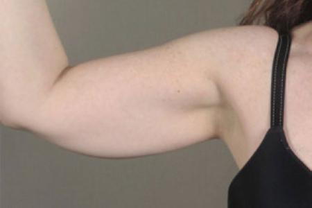 Before image 2 Case #103206 - Arm Lift Patient 12